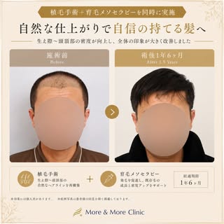 【植毛手術＋育毛メソセラピー症例】

生え際から頭頂部にかけてお悩みだった患者様。

当院では植毛手術と育毛メソセラピーを組み合わせて治療を行い、術後1年6か月で自然な密度改善がみられました。

植毛