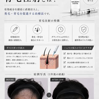 女性の患者様が多い当院ですが、男性の薄毛治療も多数ご相談いただいています。

今回ご紹介するのは、メソセラピー治療を継続された男性患者様の12ヶ月経過症例です。

治療前と比較すると、生え際の密度が向