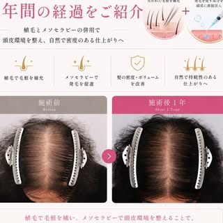 【更年期以降の薄毛でお悩みの方へ】

更年期を迎える頃から、女性ホルモンの変化によって抜け毛や髪のボリューム低下を感じる方は少なくありません。

今回ご紹介するのは、更年期以降の薄毛にお悩みだった女性