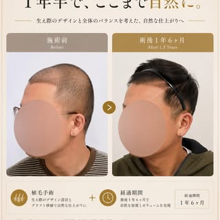 【植毛手術＋育毛メソセラピー症例】

生え際から頭頂部にかけてお悩みだった患者様。

当院では植毛手術と育毛メソセラピーを組み合わせて治療を行い、術後1年6か月で自然な密度改善がみられました。

植毛
