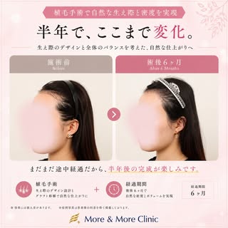 【ヘアライン矯正】手術後半年後の経過です。角ばった額を丸く、女性らしく整えました。まだまだ途中経過ですが、さらなる発育が非常に楽しみです🌷

✨許涼會院長の症例です。高生着率は基本です。満足度を高め