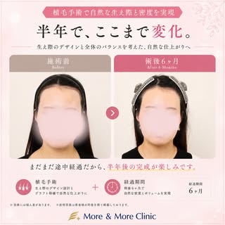 【ヘアライン矯正】手術後半年後の経過です。角ばった額を丸く、女性らしく整えました。まだまだ途中経過ですが、さらなる発育が非常に楽しみです🌷

✨許涼會院長の症例です。高生着率は基本です。満足度を高め