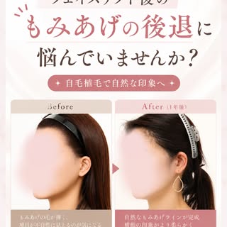 「もみあげ」が変わるだけで、横顔の印象はここまで変わります✨

今回ご紹介するのは、フェイスリフト手術で失われた「もみあげ」の植毛術 1年後の症例です。

生まれつきもみあげが薄い方や、
形が左右で違