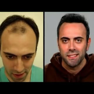 #hairsurgery#hair#transplant#results#plasticsurgery
