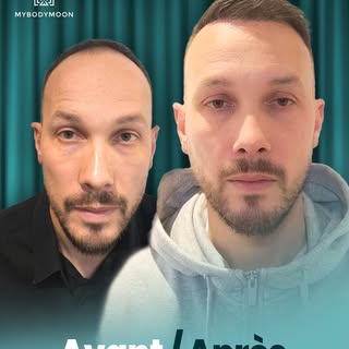 ✨ Avant ➡️ Après
Une transformation naturelle qui fait toute la différence.
Des cheveux plus denses,