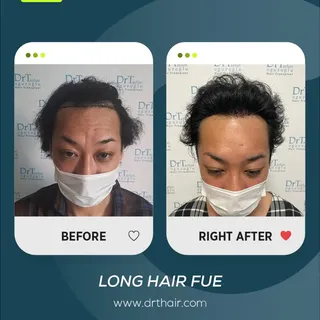A natural transformation with Long Hair FUE.

For many women, the biggest concern about hair transpl