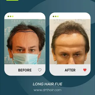 A natural transformation with Long Hair FUE.

This before and after result shows how hair transplant