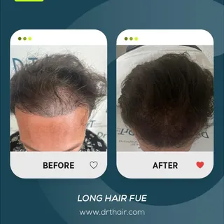 A before and after result that shows the power of Long Hair FUE.

With this technique, the hair does