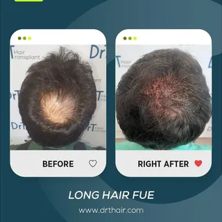 A natural-looking transformation with Long Hair FUE.

This before and after result shows how hair tr