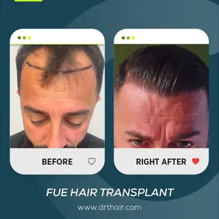 A successful FUE Hair Transplant result with a natural-looking transformation.

In this case, the go