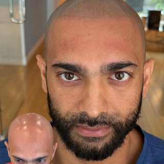 He was bald and now he’s not ‼️

@thescalpking | NYC 

#scalpmicropigmentation #smp #hairtattoo