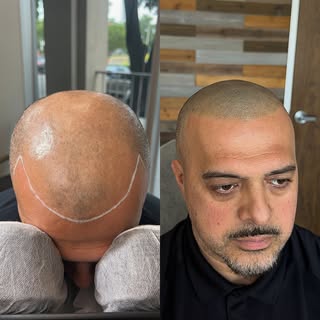 Enjoy the look of a fresh buzz cut without the need of surgery 😎 

@graigscalpmicro - HTX

#scalpmi