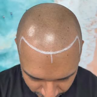 Looking 10 years younger 🤯 @derekbogs 

#hairtattoo #scalptattoo #smp