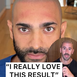 Let me explain this #scalpmicropigmentation result.  Comment below what you think of this hairline �