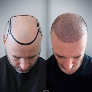 Grafts +5.200
TRANSPLANTI I FLOKËVE – DITA E 10-të! ✨
Një nga pyetjet më të shpeshta rreth transplan