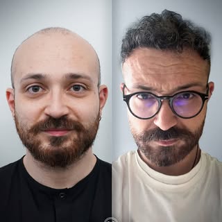 Grafts +5.400 | Para dhe Pas

Rezultatet më të mira për flokët dhe mjekrën tuaj me Murat Makascı 💫
