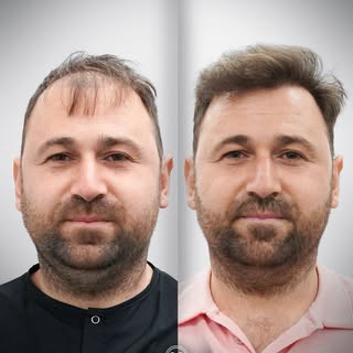 Grafts +5.300 | Para dhe Pas

Rezultatet më të mira për flokët dhe mjekrën tuaj me Murat Makascı 💫
