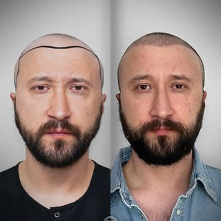 Grafts +5.650
TRANSPLANTI I FLOKËVE – DITA E 10-të! ✨
Një nga pyetjet më të shpeshta rreth transplan