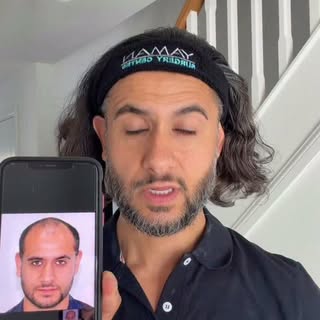 For those who are still not clear, my first hair transplant was with @drresulyaman 6 years ago, wher