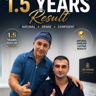 4430-Graft Hair Transplant | 18-Month Follow-Up
This patient underwent the first stage of a planned 