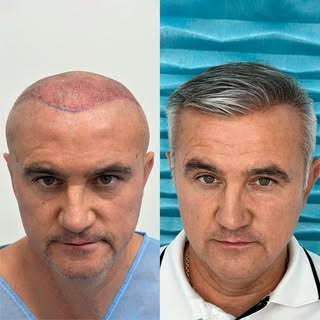 Maksymalna możliwa liczba graftów w jednym dniu zabiegowym. Rezerwuj terminy wrzesień - grudzień: 12