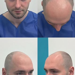 Przeszczep włosów w FullFace Clinic.
Prawdziwa historia naszego pacjenta.

👉 Zapraszamy na bezpłatn