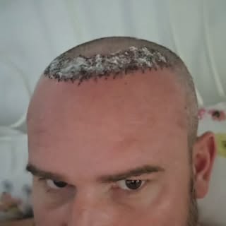 A venit momentul mult asteptat de mine! scot bandajele! 😁 De astazi am voie sa ma spal pe cap! yuhu