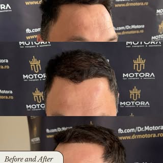 Before & After - #HairTransplant 💉

Most people wouldn’t guess what the before looked like.
Swipe l
