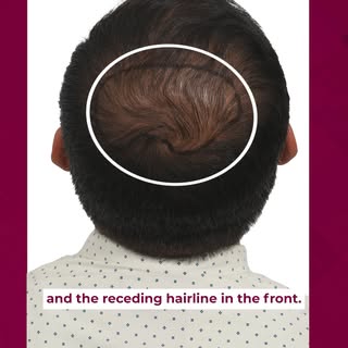 Three years of hair loss. Multiple clinic visits. Endless research.

Before making his decision, Gau