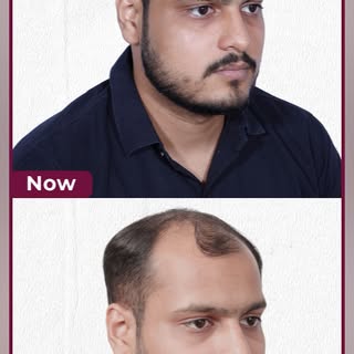 Three years of hair loss. Multiple clinic visits. Endless research.

Before making his decision, Gau