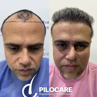 🧔 Regeneración frontal, hair line, entradas y picos temporales

📋 Diagnóstico: AAG III V
🧪 Unidad