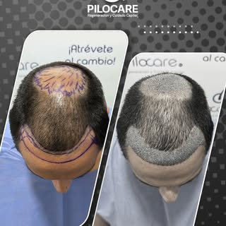 🧬 Diagnóstico: AAG IV
💉 Procedimiento: Restauración capilar en línea frontal (hairline) y coronill