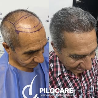 🧔 Regeneración total de cabeza

📋 Diagnóstico: AAG V
🌱 Unidades Foliculares: 3,743
🌿 Folículos/C