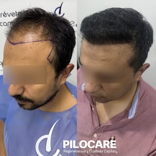 🧔 Regeneración frontal

📋 Diagnóstico: AAG III 
🧪 Unidades Foliculares: 3,284
🌿 Folículos/Cabell