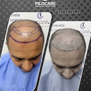 📄 Diagnóstico: AAG III V Difuso y pilares
✨ Procedimiento: Regeneración frontal, coronilla y candad
