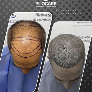 🧔 Regeneración total de cabeza

📋 Diagnóstico: AAG V
🌱 Unidades Foliculares: 3,743
🌿 Folículos/C
