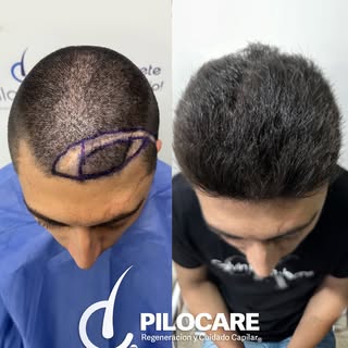 📄 Diagnóstico: Cicatriz postraumática 🧬
✨ Procedimiento: Regeneración de cicatriz postraumática 🔥