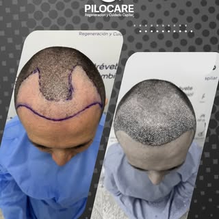 📄 Diagnóstico: AAG III A 🧬
✨ Procedimiento: Regeneración Frontal, Hair Line y Entradas mediante té