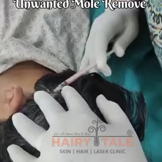 ✨Say Goodbye to Unwanted Moles! 🧏🏻✨