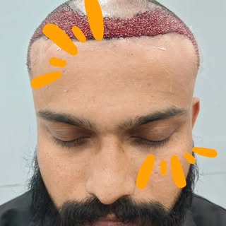 ✨Pune's No 1 Hair Transplant Clinic✨

Hairy Tale Hair Transplant seems to be a medical clinic or cen