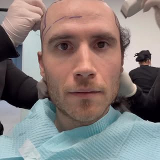POV: You’re balding. Thank you @parsamohebihairrestoration