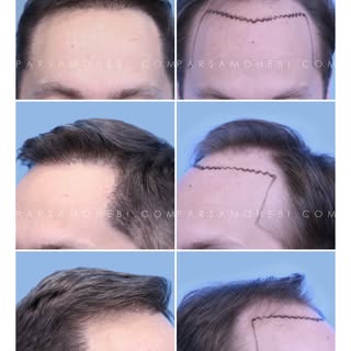 3250 grafts FUE hair transplant to restore his hairline and improve density while maintaining a natu