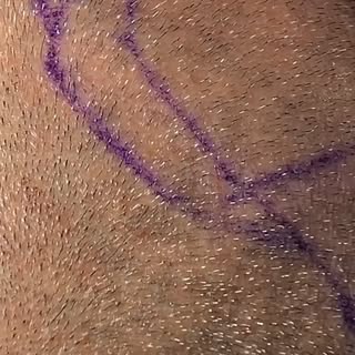 How many hairs are in a graft?

#HairLine #HairTok #HairTransplant #HairJourney #hairtransformation 