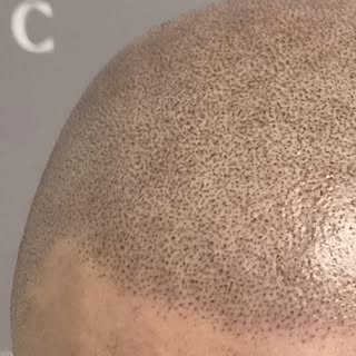 NOUVEAU LOOK 
#micropigmentation #tricopigmentation #tattoo #suddelafrance #summer