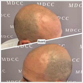 La 3ème et dernière séance se termine...BUE BYE la calvitie!! 

#micropigmentation #tricopigmentatio