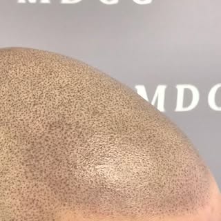 Zoom sur le détail de cette 3ème séance.
Effet hyper réaliste 

#micropigmentation #cheveux #look #t