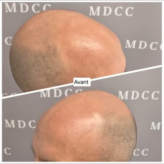 AVANT et Après la 2ème séance 

#micropigmentation #tricopigmentation #tattoo #toulon #marseille