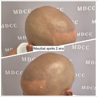 RETOUCHE APRÈS 2 ANS
#micropigmentation #micropigmentationcapillaire #tricopigmentation #tattoo #tou