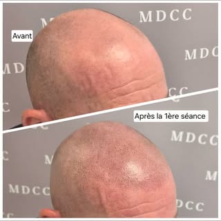 Un premier cap de passé!
1ère séance 
#micropigmentation #tricopigmentation #tattoo #toulon #marseil