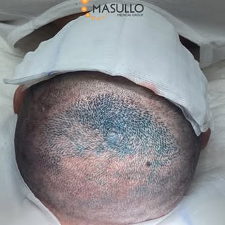 Il vertex (la zona della "chierica") è una delle aree più difficili da ricostruire in un trapianto d